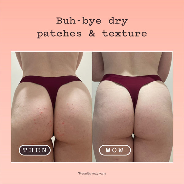Before-and-after comparison showing the back of a woman's buttocks with red dry patches and texture in the 'THEN' panel and clearer skin in the 'WOW' panel, under the headline 'Buh-bye dry patches & texture'.
