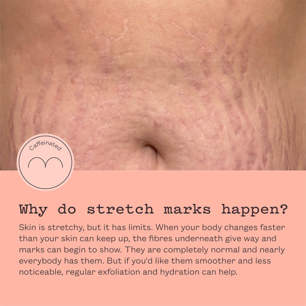 A close-up of stretch marks on skin with a peach-colored text panel below reading 'Why do stretch marks happen?' and a circular 'Caffeinated' badge on the left.